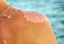 Ilaçi më i mirë për djegiet nga dielli gjendet në kuzhinën tuaj