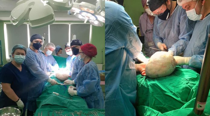 Realizohet intervenim i vështirë kirurgjik në Spitalin e Mitrovicës, pacientit i hiqet një pjesë tumori prej 8 kilogramësh