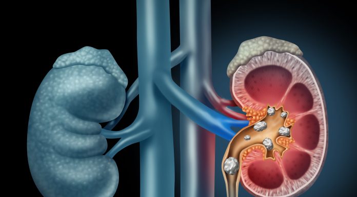 Çfarë i shkakton gurët në veshka?