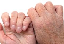 Lëkura e ashpër nga të ftohtit