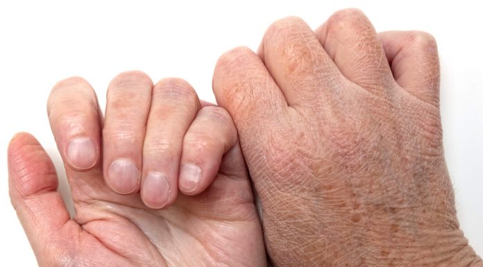 Lëkura e ashpër nga të ftohtit