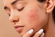 Pesë shenja të mungesës së vitaminave që nuk duhen anashkaluar